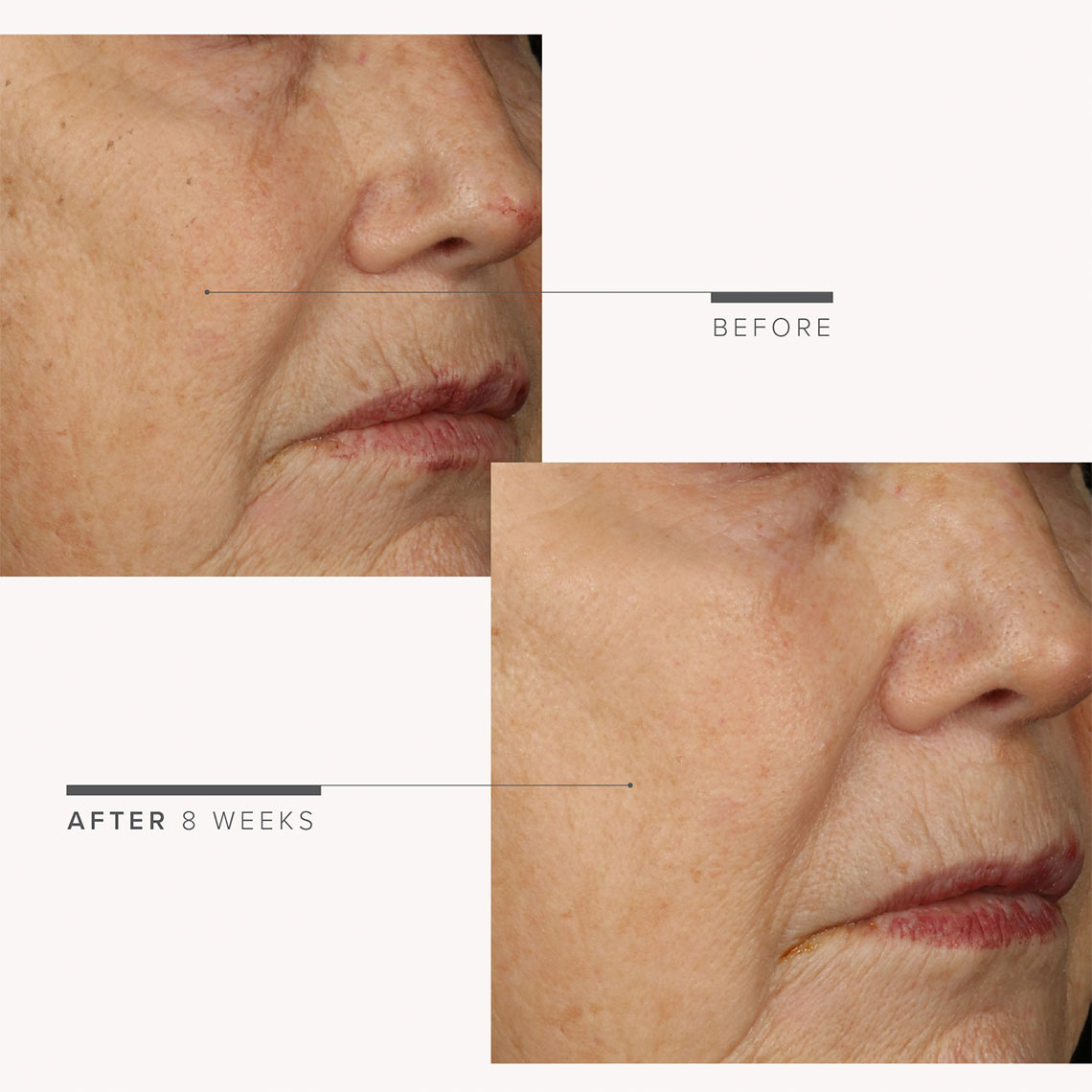 REVERSE Regimen before and after 8 weeks images. REVERSE Regimen before and after 8 weeks images.