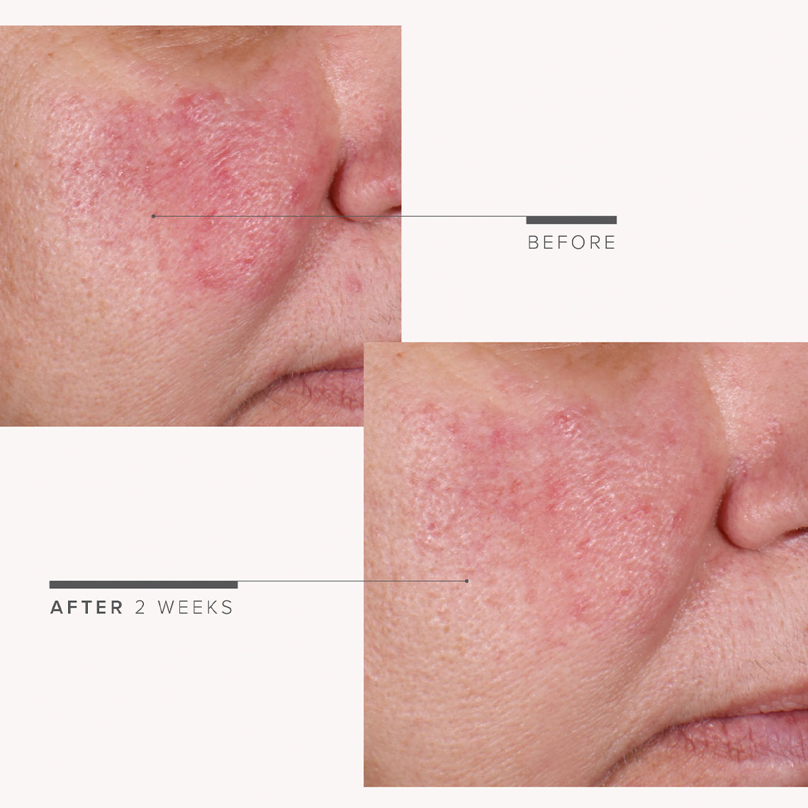 SOOTHE Regimen before and after 2 weeks images. SOOTHE Regimen before and after 2 weeks images.