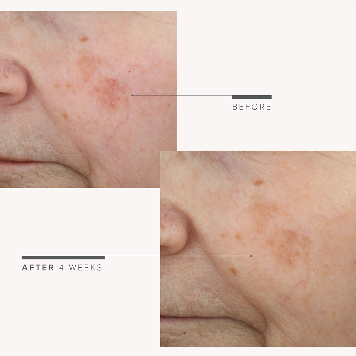 Targeted Dark Spot Corrector before and after 4 weeks images. Targeted Dark Spot Corrector before and after 4 weeks images.