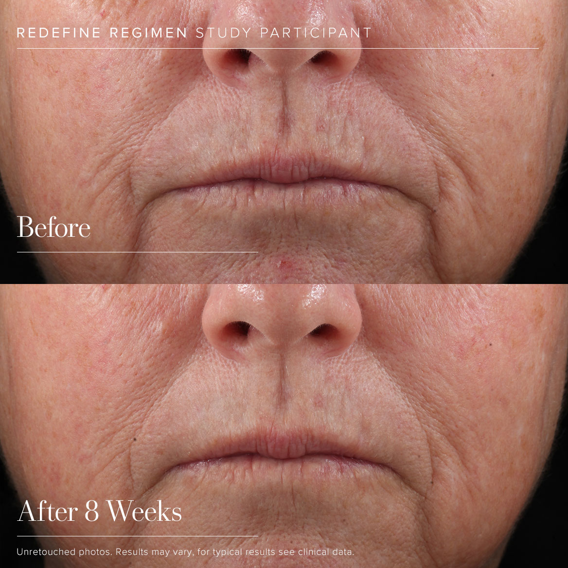 REDEFINE Regimen - Before & After