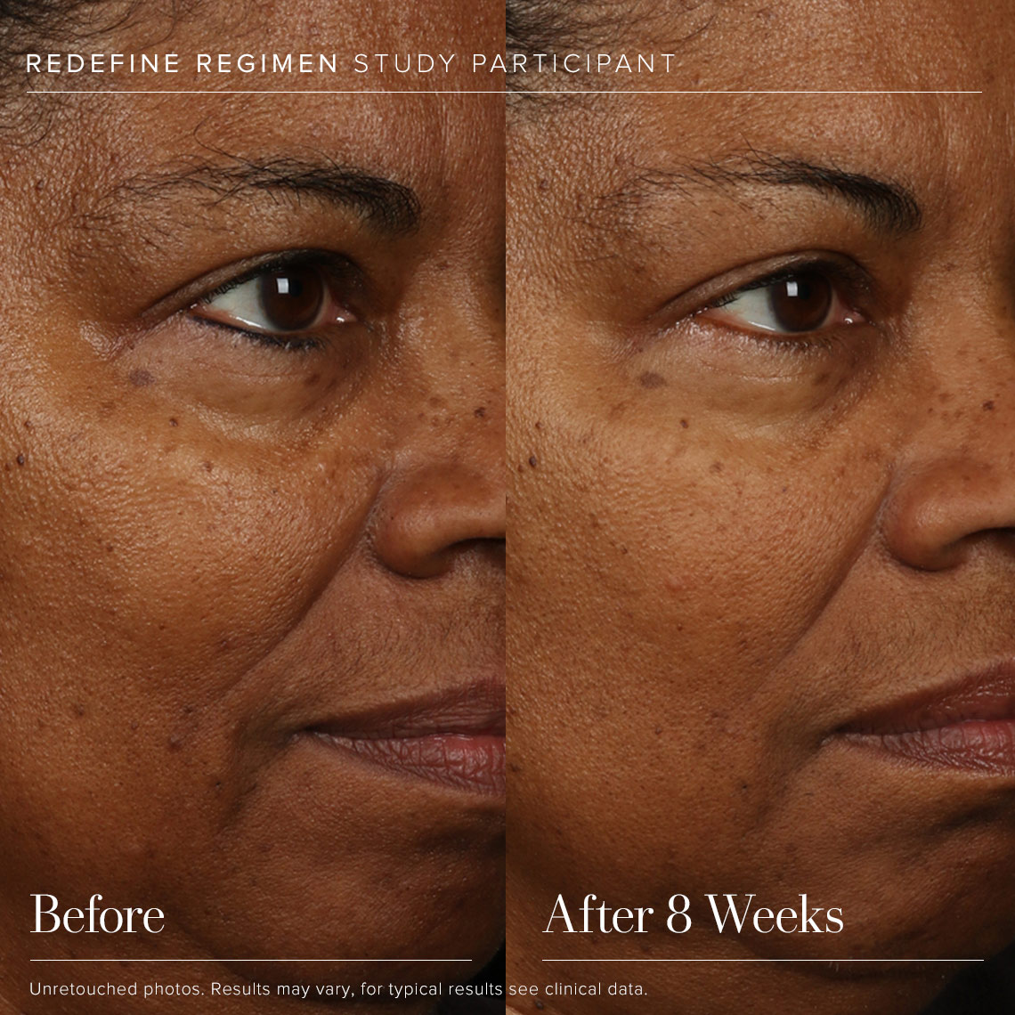 REDEFINE Regimen - Before & After