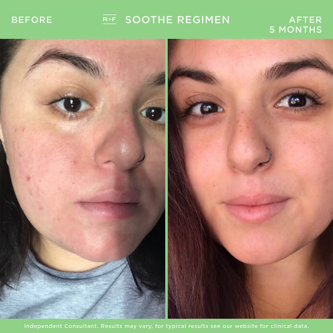 SOOTHE Regimen