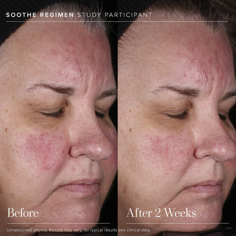 SOOTHE Sensitive Skin Treatment