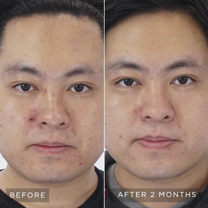 Before and after images of Study Participant after using UNBLEMISH Regimen for 2 months. Before and after images of Study Participant after using UNBLEMISH Regimen for 2 months.