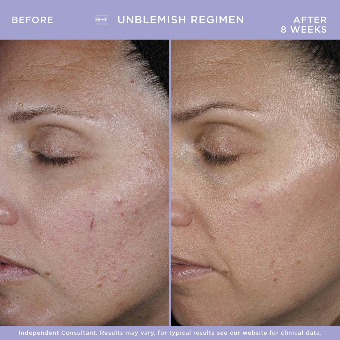 UNBLEMISH Regimen