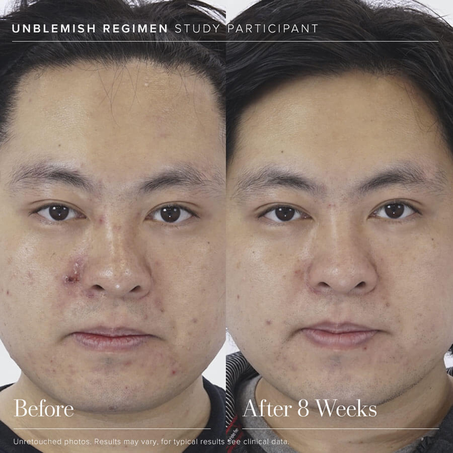 UNBLEMISH Refining Acne Wash