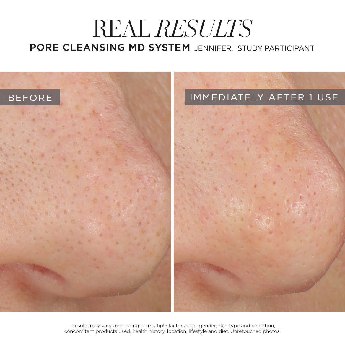 Pore Cleansing MD System