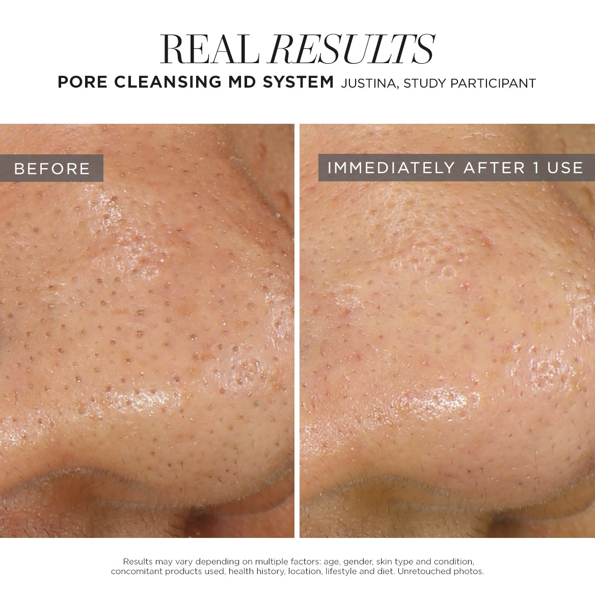 Pore Cleansing MD System