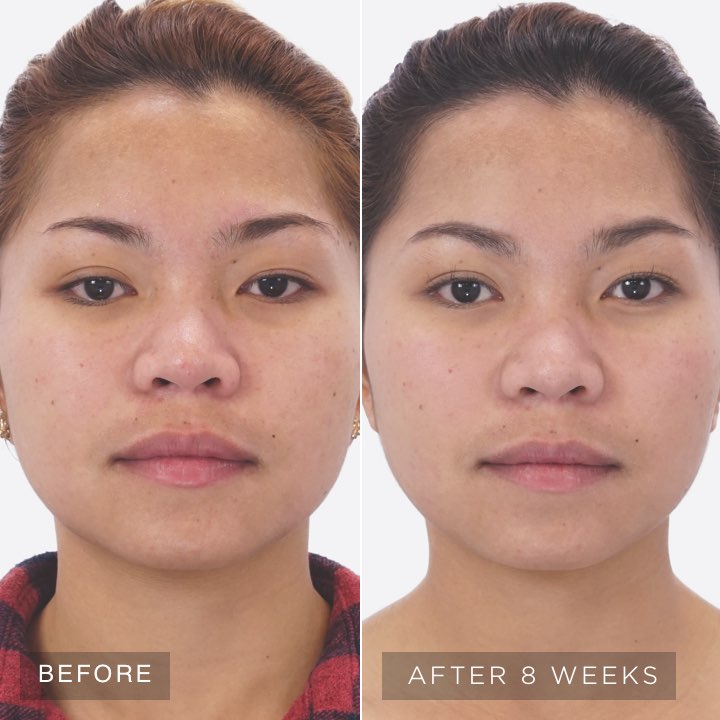 Before and After Recharge Regimen Before and After Recharge Regimen