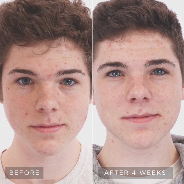 skincare-philosophy-visible-results-4-vertical-image-teen-acne-right2-d.jpg skincare-philosophy-visible-results-4-vertical-image-teen-acne-right2-d.jpg