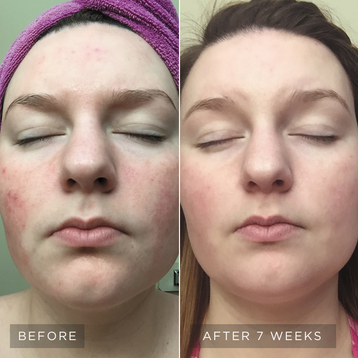 skincare-philosophy-visible-results-4-vertical-image-visible-redness-left2-d.jpg skincare-philosophy-visible-results-4-vertical-image-visible-redness-left2-d.jpg